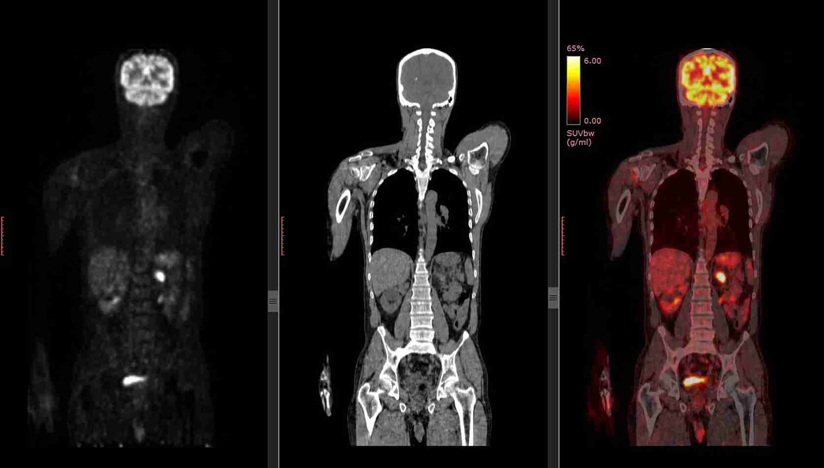 Robotic Surgery Kidney Disease Mumbai