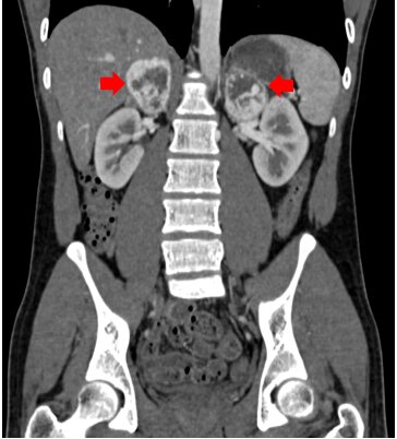 Robotic Surgery Kidney Disease Mumbai