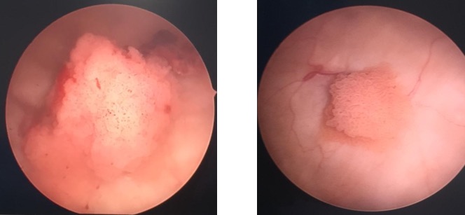 Robotic Surgery Kidney Disease Mumbai