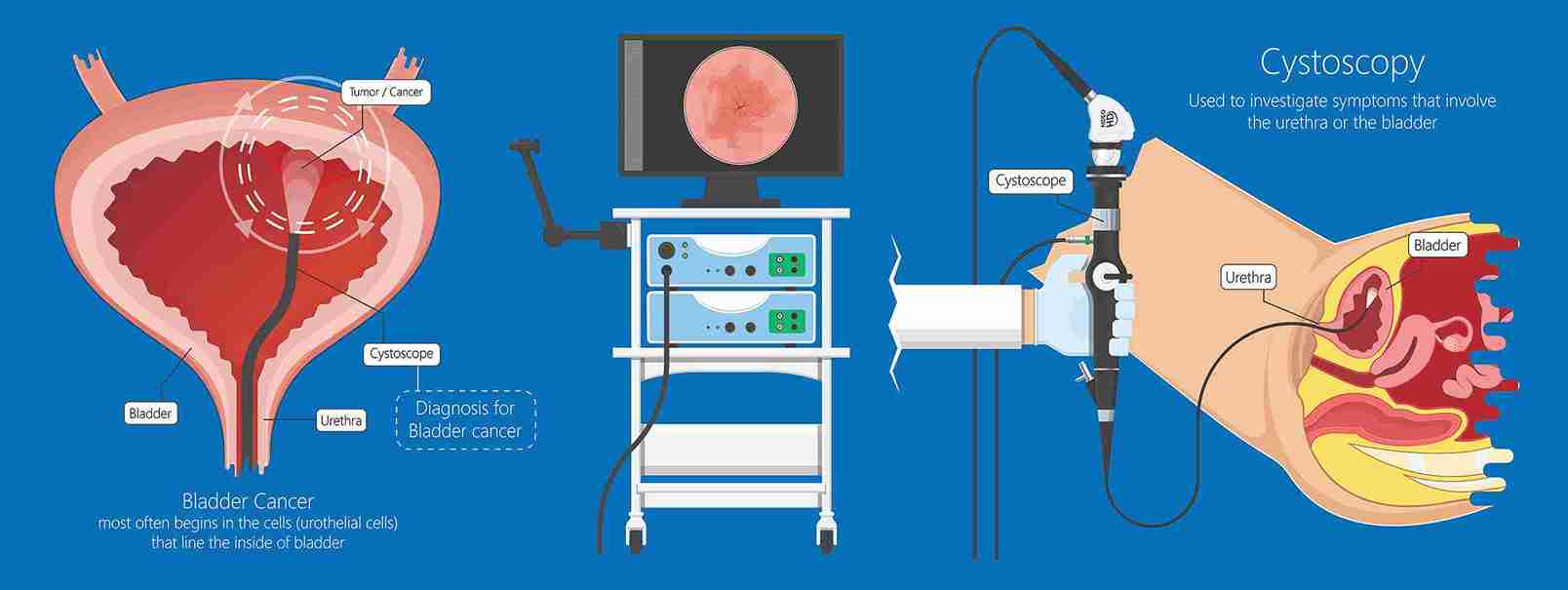 Hematuria Surgery Mumbai