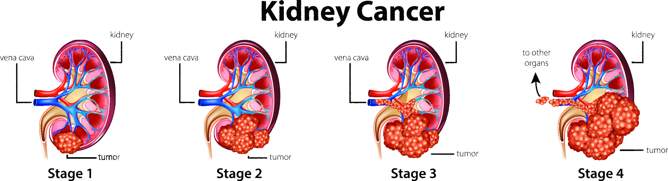 Advanced Kidney Cancer Surgery Mumbai