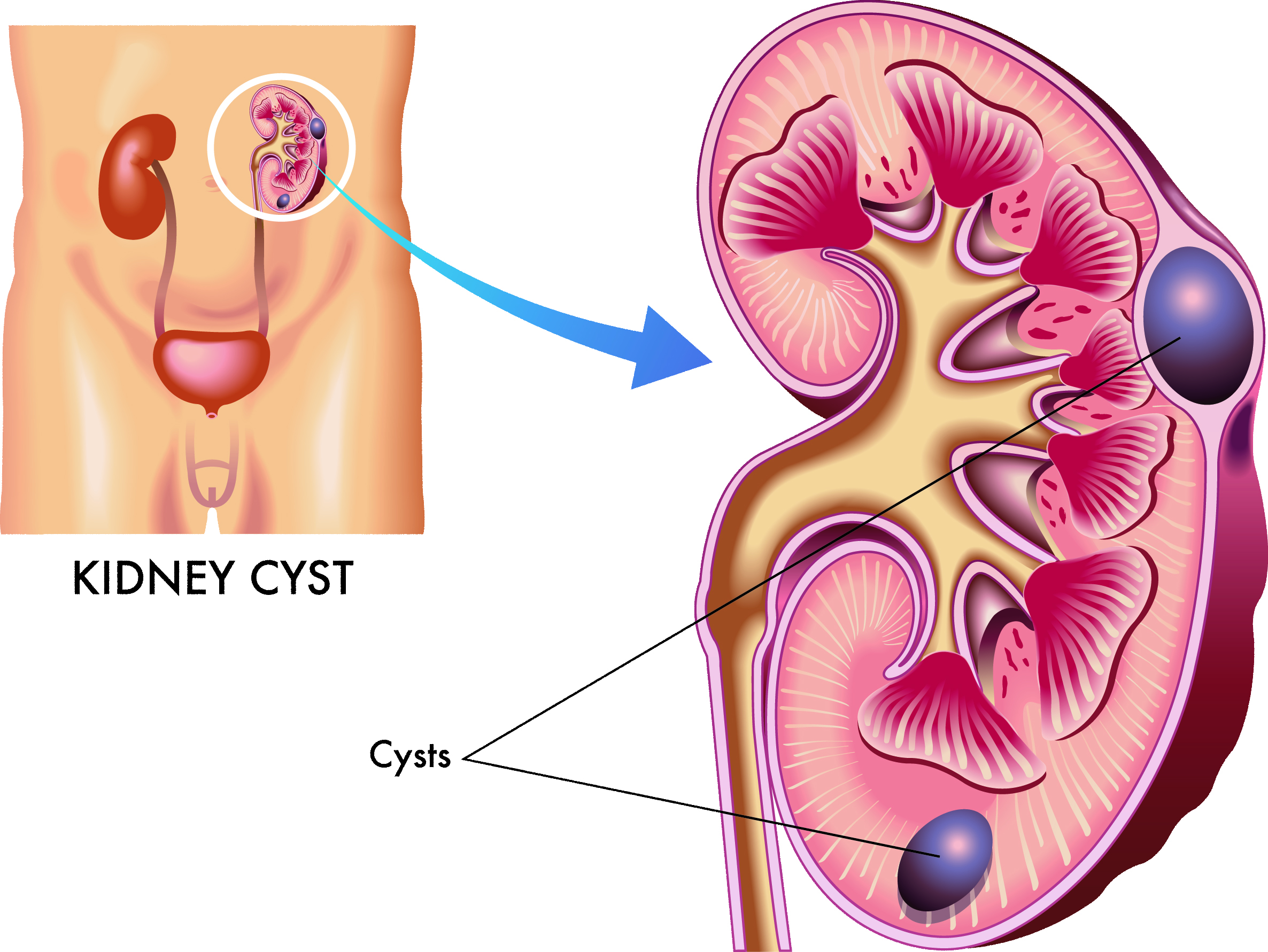 Kidney Cyst Surgery Mumbai