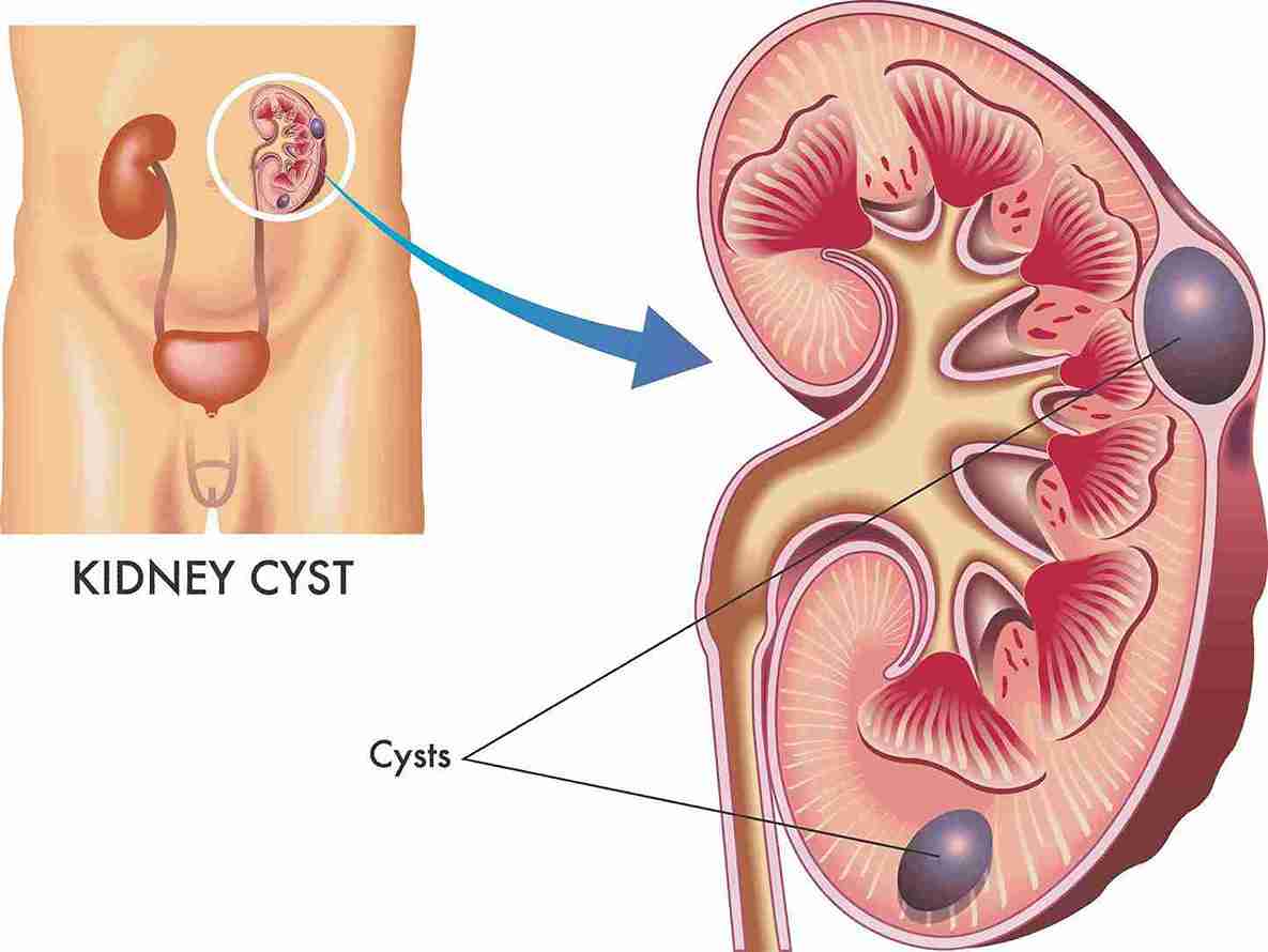 Kidney Cyst Surgery Mumbai