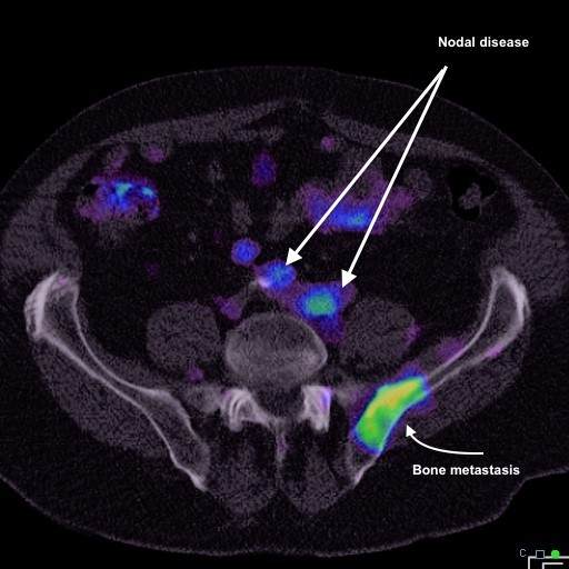 Prostate Biopsy Mumbai