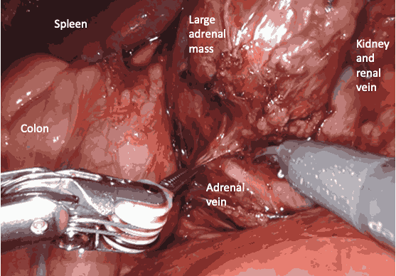 Robotic Surgery Kidney Disease Mumbai