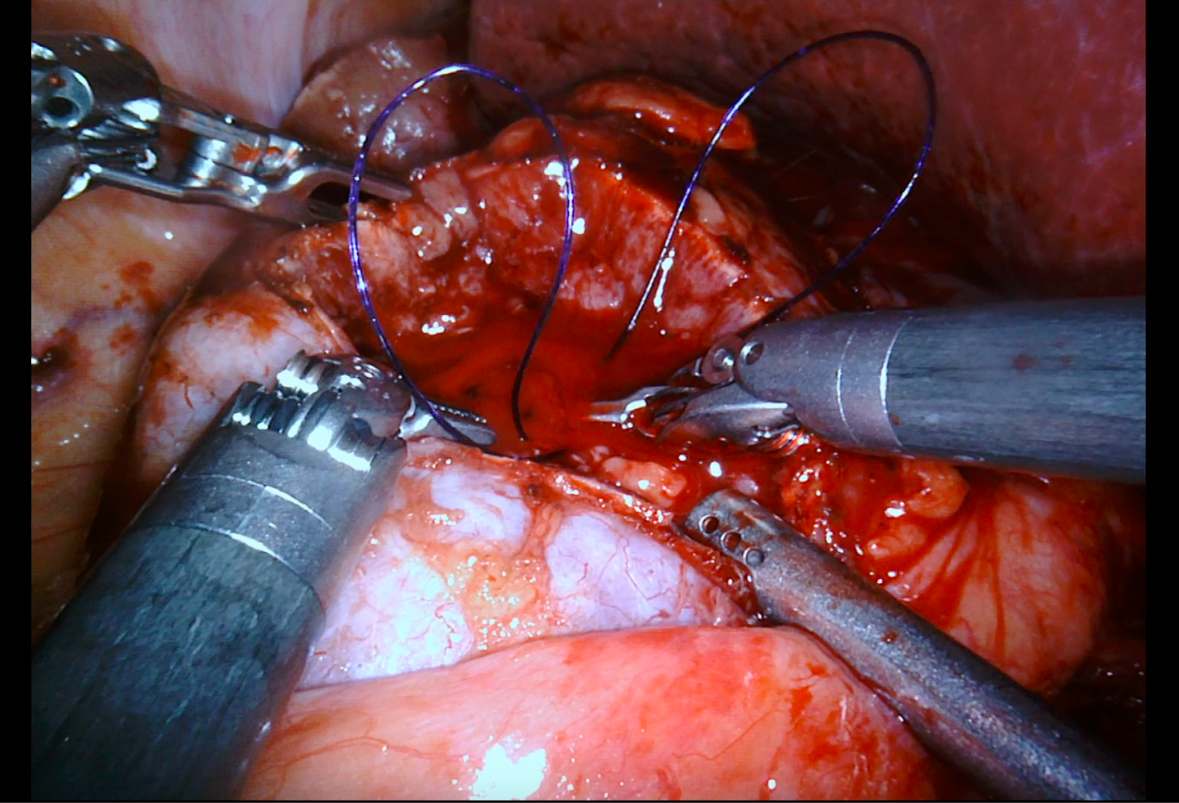 Robotic Surgery Kidney Disease Mumbai