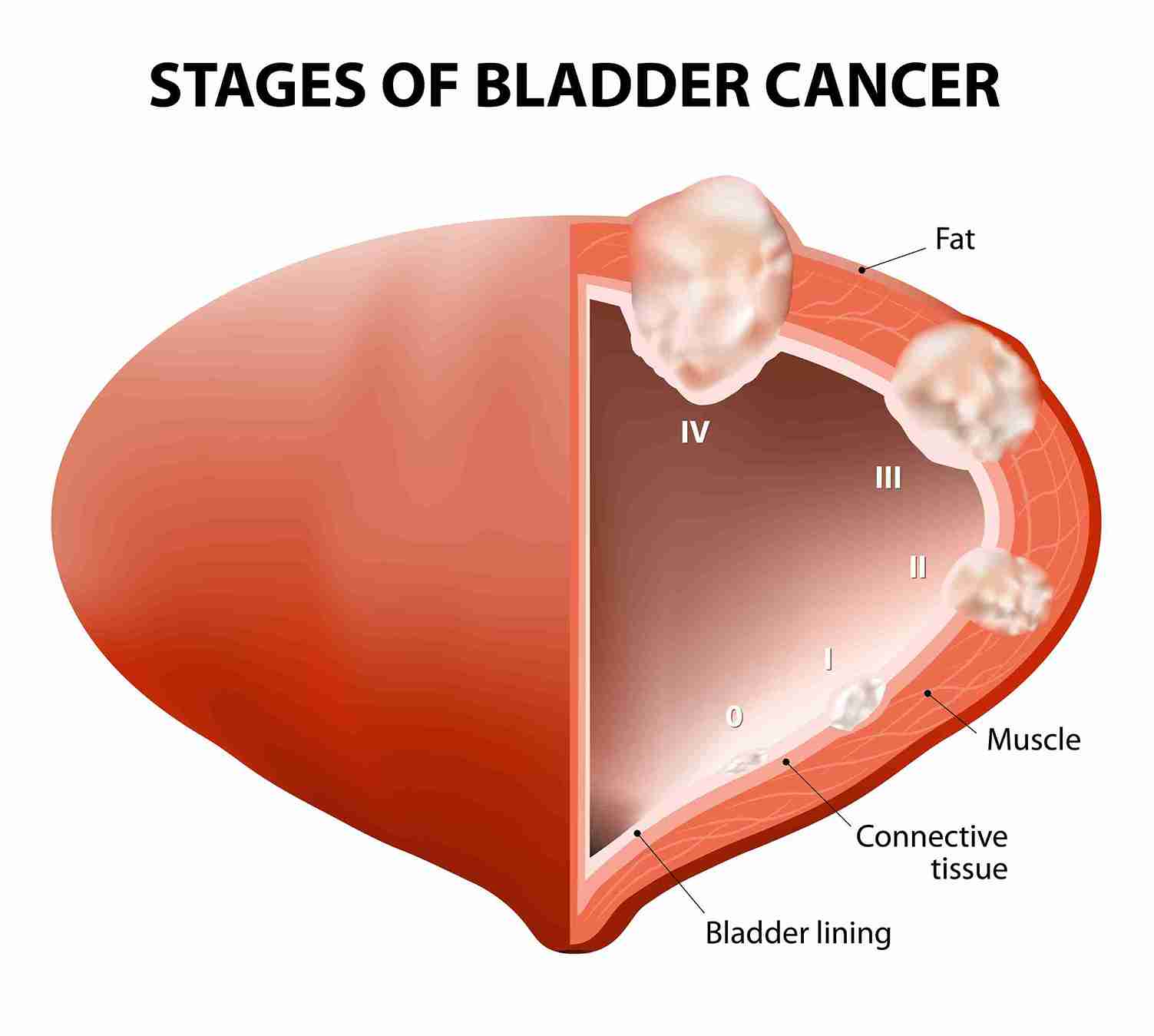 Robotic Surgery Kidney Disease Mumbai