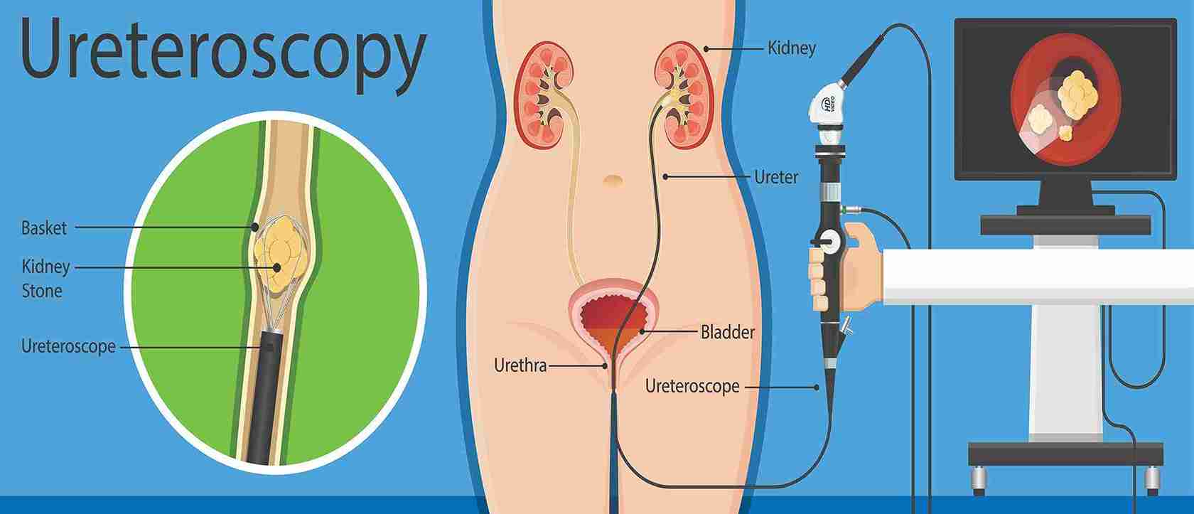 Ureter Renal Pelvic Cancer Surgery  Mumbai